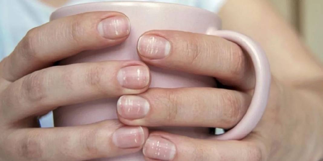 Vitamin eksikliği sandığınız çizgiler ipucu olabilir! Vitamin eksikliği mi, başka bir sorun mu? İşte cevabı… 1